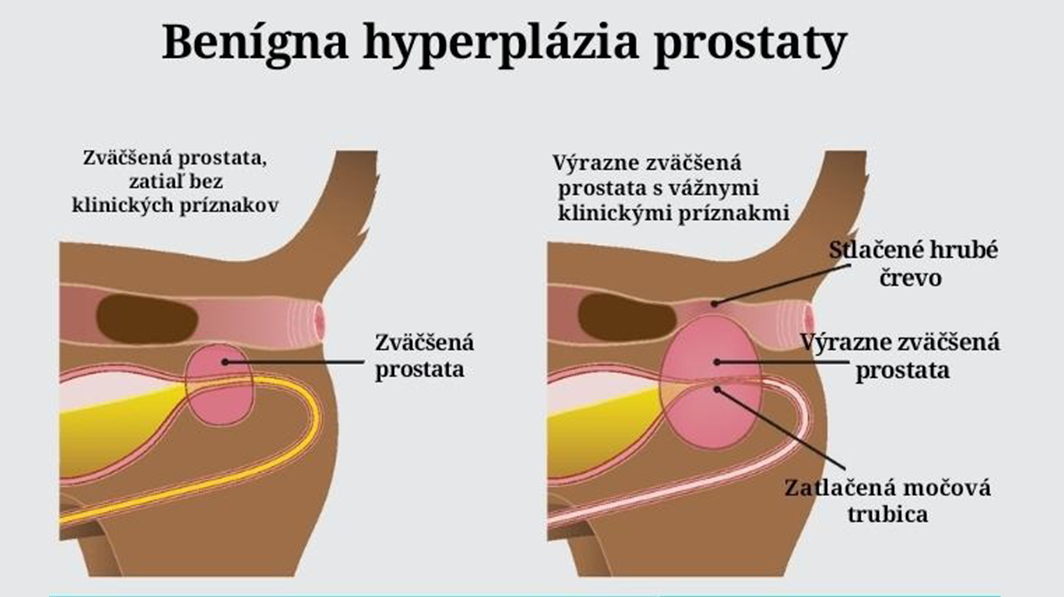 benigna hyperplazia prostaty